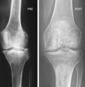 "knee