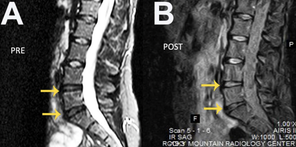 disc regeneration from bone marrow stem cells