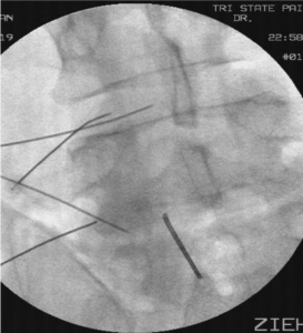 can stem cells treat radiculopathy